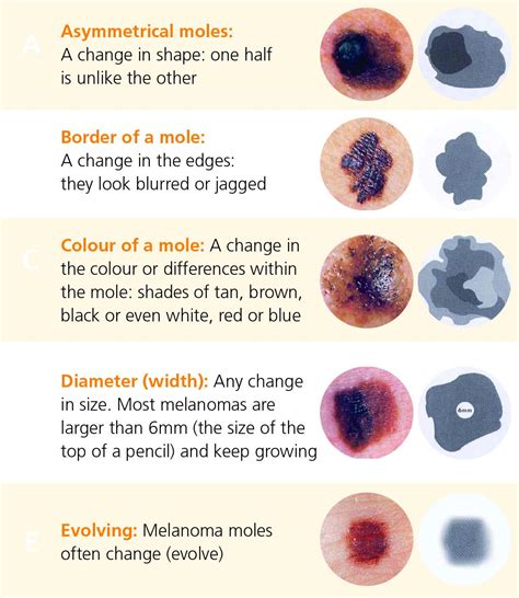 signs  melanoma skin cancer
