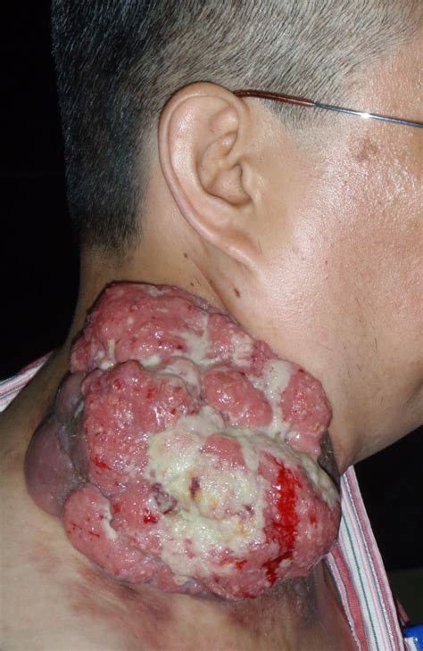 圖片搜尋： 鼻咽癌