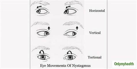 heres      control  uncontrolled eye movements explains dr sachdev