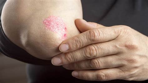 How To Prevent Psoriasis Outbreaks With Diet 7 Diet Tips