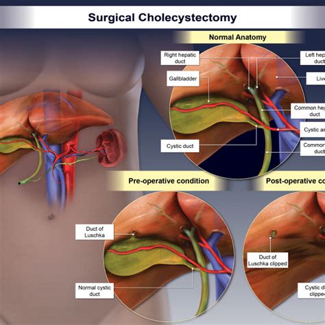 Surgical Cholecystectomy Trialexhibits Inc