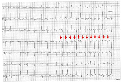 ecg channel atrial tachycardia