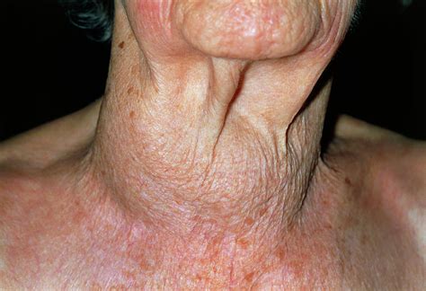 elderly woman s swollen neck due to thyroid cancer photograph by dr p