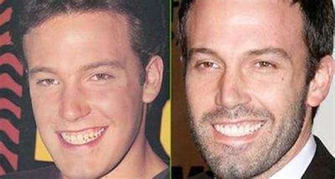 celebrities  fake teeth list  famous people  dentures