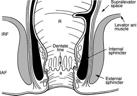 ischiorectal abscess fistula