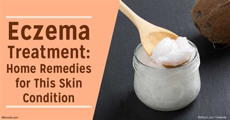treat eczema
