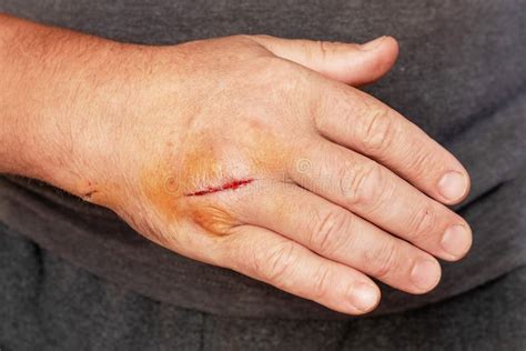 mans hand   cut wound  cut hand stock image image  damaged