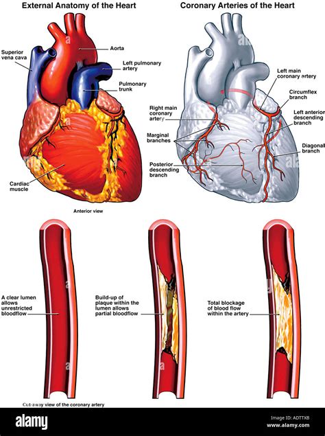 coronary artery blockage  res stock photography  images alamy