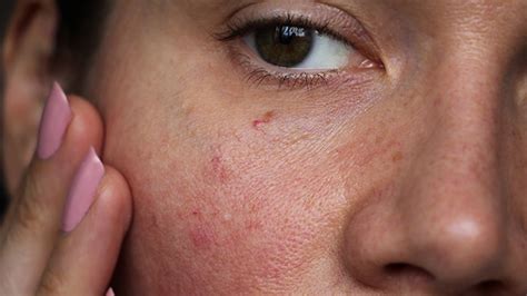exfoliating  acne facial adviser