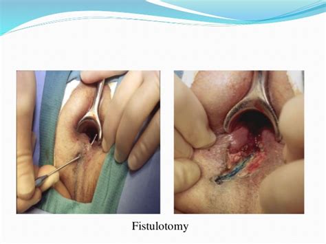 anal fistulotomy mature milf
