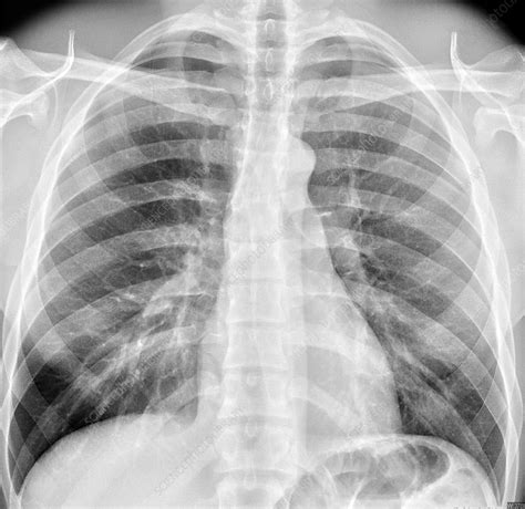 Normal Chest X Ray Stock Image C036 6403 Science Photo Library