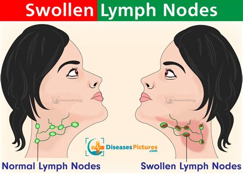 swollen lymph nodes symptoms   neck  groin treatment