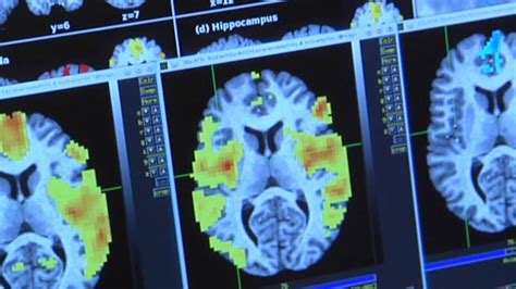 Investigating Drug Abuse Brain Imaging Youtube
