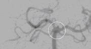 aneurysma im kopf gehirn vor der operation operationen facharzt