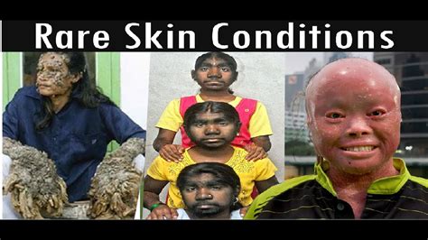 Top 4 Most Rare Skin Disorders In The World That You Always Thought