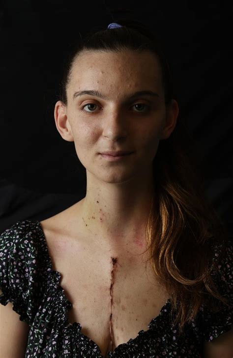 Teenager Zoe Gardiner Wears Scar With Pride While Recovering From Fifth
