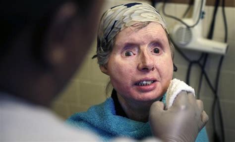 Chimp Attack Victim Helps Military Learn From Face Transplant The