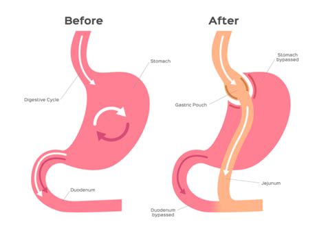 Gastric Bypass Vs Gastric Sleeve Which One Is Right For You