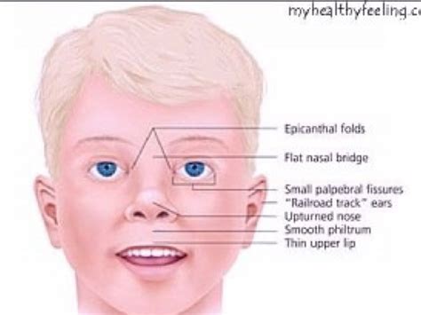 Prader Willi Syndrome By Brighan Stanley
