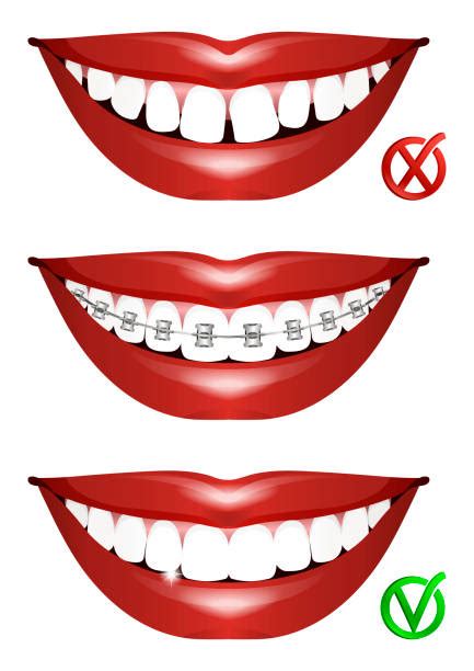Best Orthodontic Smile Illustrations Royalty Free Vector Graphics