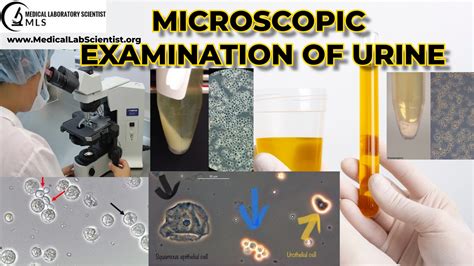 microscopic urinalysis medical laboratory scientist mls