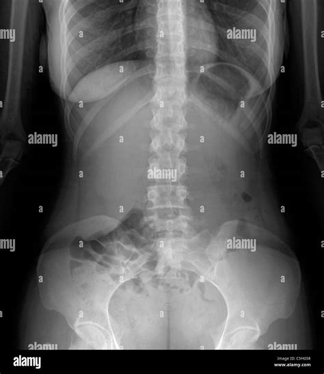 abdomen normal rayos  fotografia de stock alamy