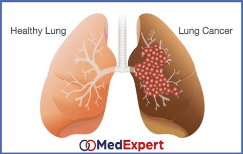Lung Cancer Treatment Types Symptoms And Diagnosis Med Expert