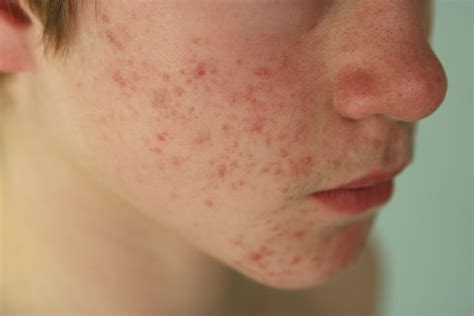 skin conditions pictures symptoms treatment