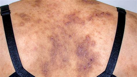 What Does Hiv Rash Look Like And How To Treat It Health