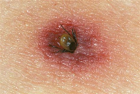 tick bites  humans images symptoms  treatment hubpages