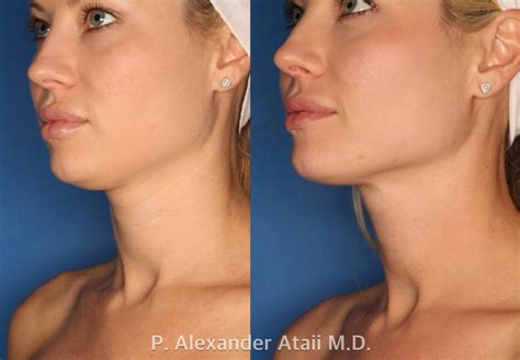 ultherapy before after fairfax plastic surgery fairfax