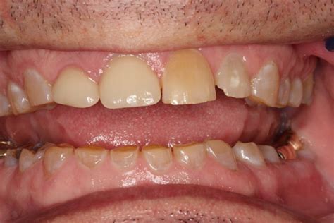confidently address tooth wear issues  systematic approach