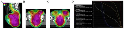 intensity‑modulated radiotherapy for synchronous cancer of the anal