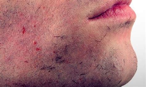 Ingrown Facial Hair Cyst Bump Deep Infection Causes