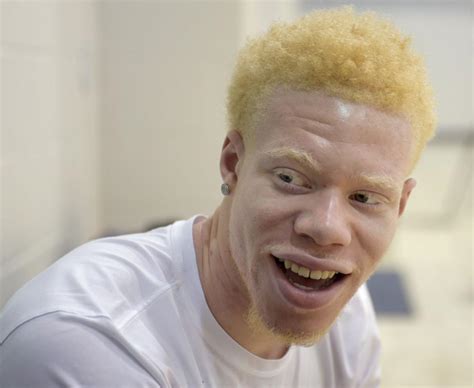 tcu athlete  albinism embraces  life appearance  america phillytribcom