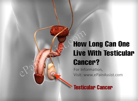 how long can one live with testicular cancer