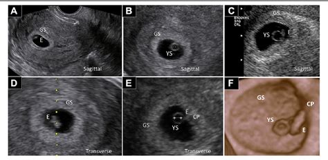 Diagnosis Of Placental Position By Early First Trimester Ultrasound A