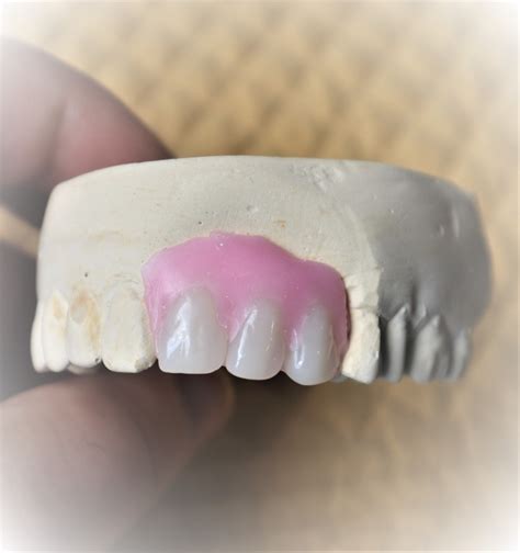 Dentures Kit Missing Tooth Acrylic Teeth Veneer Kit Shade Etsy
