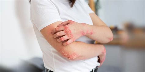 understanding  treating fungal infections  fungal infection
