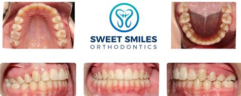 Gallery Sweet Smiles Orthodontics