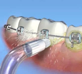 waterpik water flosser nc oral surgery  orthodontics