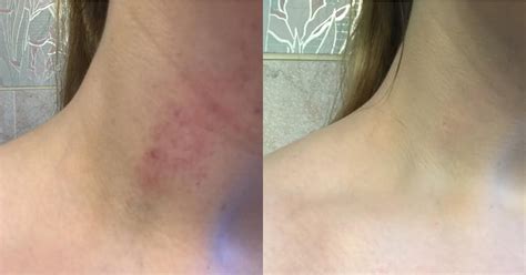 the results how to get rid of a hickey popsugar beauty photo 9