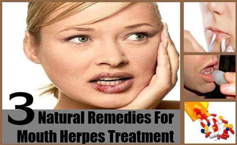 natural remedies for mouth herpes treatment how to get rid of herps natural home remedies buzz