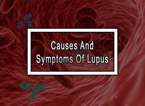 symptoms  lupus hanapph