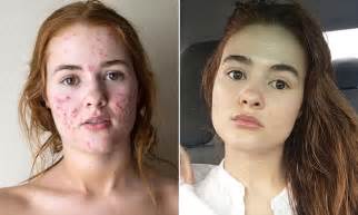 ohio woman posts before and after acne instagram photos daily mail online