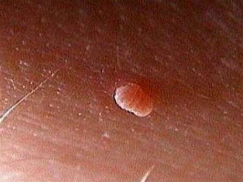 home remedies reviews removing moles skin tag removal and