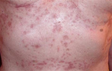 papular eczema symptoms   treatment
