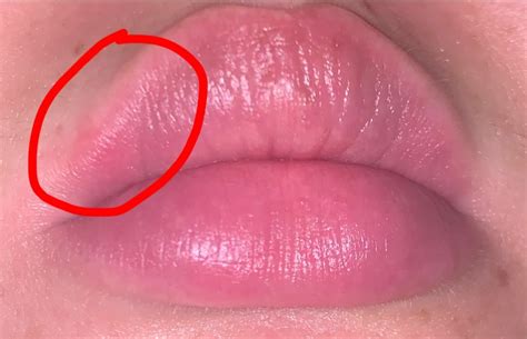 Is This Oral Herpes Help Please Sexual Health Forums Patient