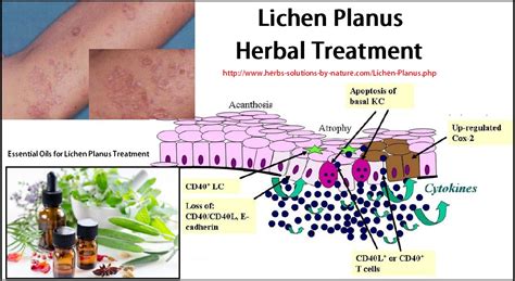 lichen planus causes symptoms diagnosis and herbal treatment herbs