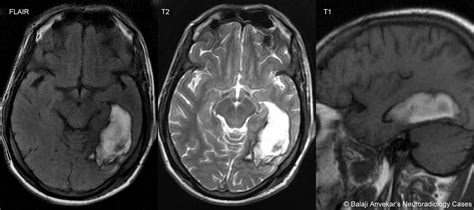 Dr Balaji Anvekar Frcr Intracerebral Hematoma Late